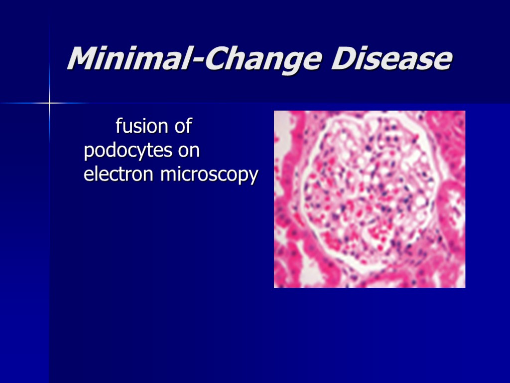 Minimal-Change Disease fusion of podocytes on electron microscopy